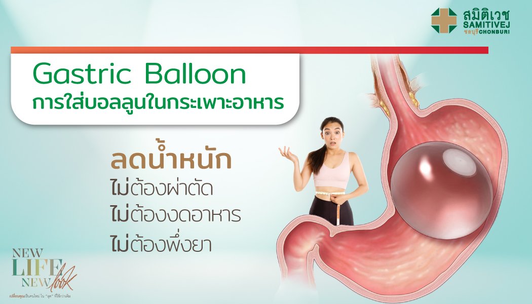 การใส่ลูก Gastric Balloon ในกระเพาะอาหาร