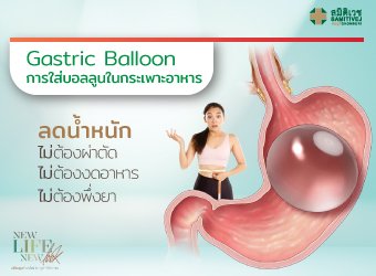 การใส่ลูก Gastric Balloon ในกระเพาะอาหาร_2